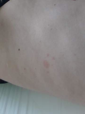 Auf dem stuhl waren schleimauflagerungen, der stuhl selbst hatte eine normale farbe und war hart und trocken. Was ist das? Sieht aus wie hautkrebs oder? (Gesundheit und ...