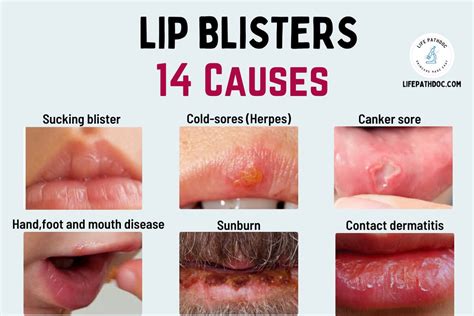 Blister On Lip Cold Sores And Other Causes With Pictures
