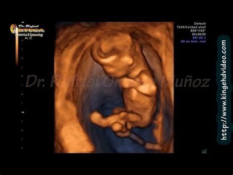 Prenatal genetic screening may continue this week with a nuchal translucency test. 4D ultrasound pregnancy of 11 weeks fetus moving and ...
