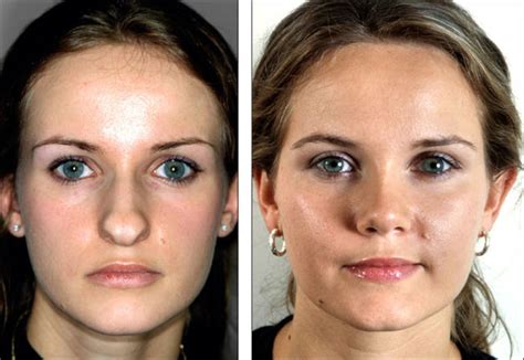 Before And After Pictures Show How A Nose Job Can Change Your Face Pics