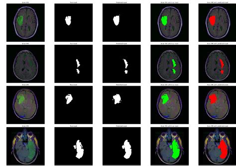 Brain Tumor Classification And Detection From Mri Images Using Cnn
