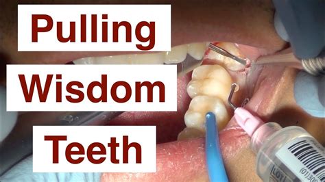 How Long To Keep Gauze In After Wisdom Tooth Extraction Inspire