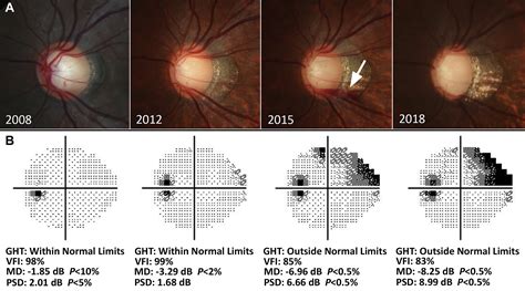 Development Of Glaucoma After Myopic Optic Disc Change In A Teenage