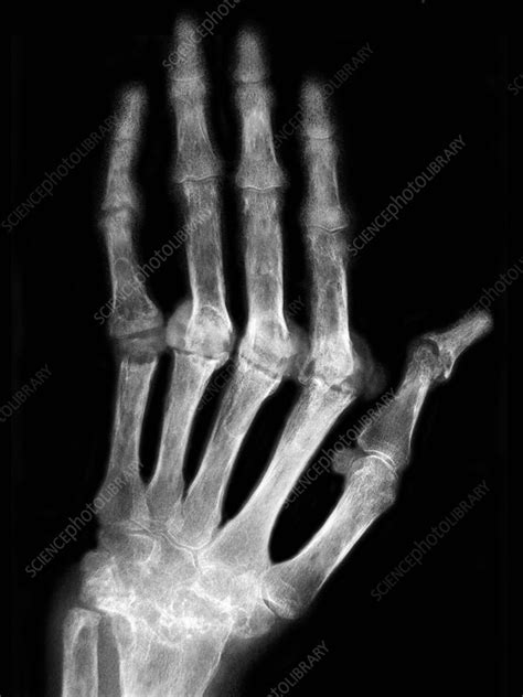 Marginal erosions in the affected joints, periarticular osteoporosis, and generalized bone loss in unclassified polyarthritis and early rheumatoid arthritis is better detected by digital x ray radiogrammetry than dual x ray. Rheumatoid Arthritis, X-ray - Stock Image - C027/2197 ...