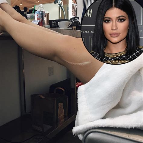 Kylie Jenner Flaunts Huge Leg Scar Is Kendall To Blame For It