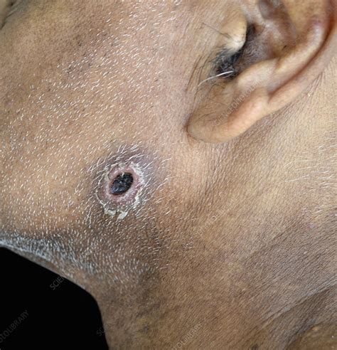 Gangrenous Ecthyma Stock Image C0473486 Science Photo Library