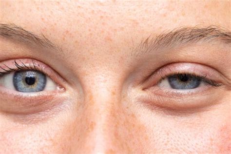 Painful Bump On Eyelid Causes And Treatment