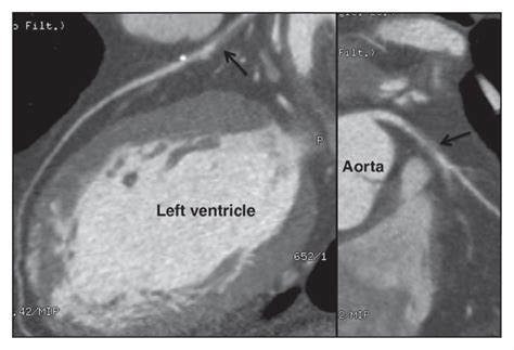 Coronary Computed Tomography Angiography Cmaj