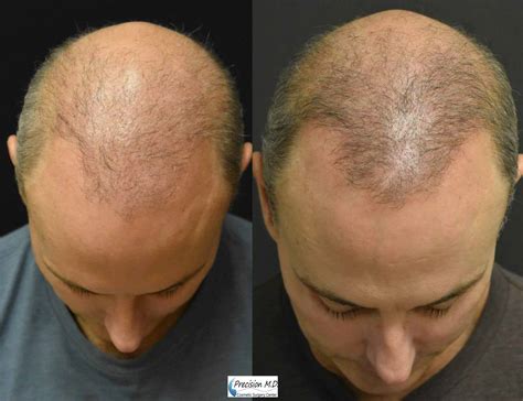Before And After Hair Restoration Showing The Top Of Man S Head