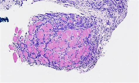 Epithelioid mesothelioma is the most frequent histologic type of. Pathology Outlines - Mesothelioma - epithelioid