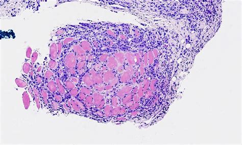 These symptoms can be caused by mesothelioma, but more often they are caused by other conditions. Pathology Outlines - Mesothelioma - epithelioid