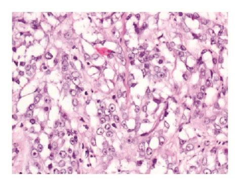 Histologic And Immunophenotypic Features Of Collecting Duct Carcinoma