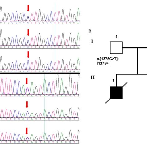 A Sanger Sequencing Electropherograms Showing Compound Heterozygous Download Scientific