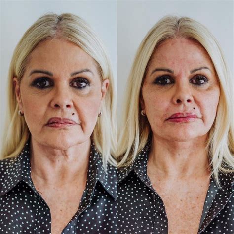 Foto Antes e depois Monique Evans fez harmonização facial e realçou seus traços Purepeople