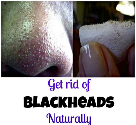 Diy Homemade Blackheads Strips Within 30 Seconds Get Rid Of