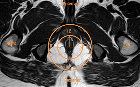 MRI Of Perianal Fistulae A Pictorial Kaleidoscope Clinical Radiology