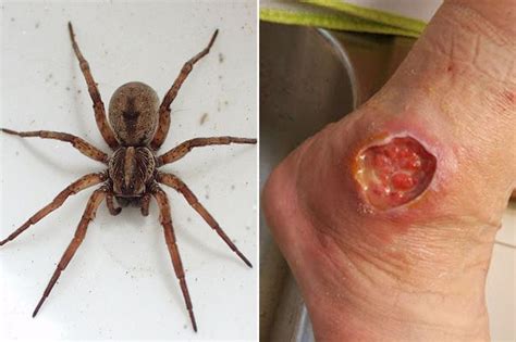 Spider control can be a major concern for homeowners — particularly for those who live in the southwest. Stomach-churning clip shows massive spider bite becomes a ...