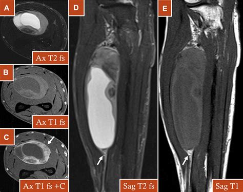 The Imaging Spectrum Of Synovial Sarcomas A Pictorial Review From A