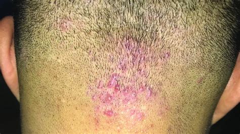 Folliculitis Of Scalp Treatment In Bangalore Furunculosis