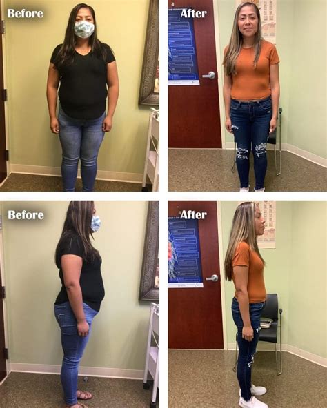 Great Semaglutide Ozempic Weight Loss Before And After Pictures Learn