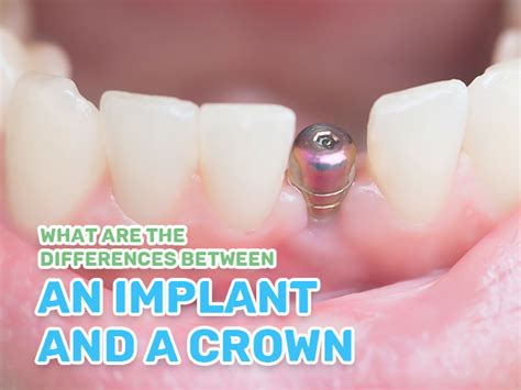 Dental Implants Vs Crowns Understanding The Key Differences