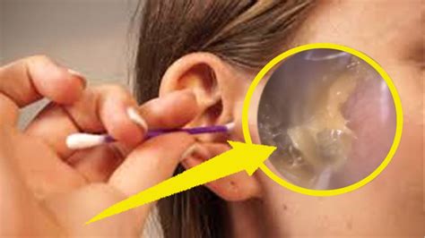 Ear Wax Stuck On Eardrum Remove For You Youtube