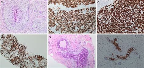 Features Of Primary Male Breast Cancer Mbc Metastases To The Male