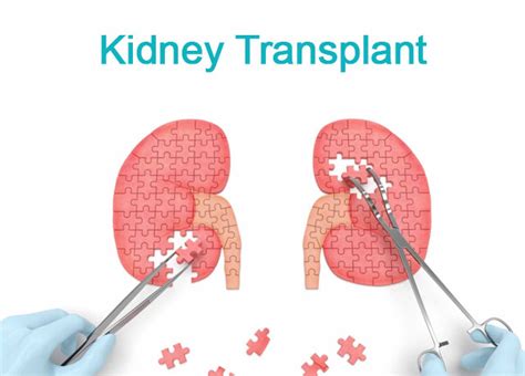 Kidney Transplant The Surgical Procedure To Place A Healthy Kidney