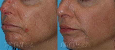 Acne Scars Before And After Photos Chevy Chase Facial
