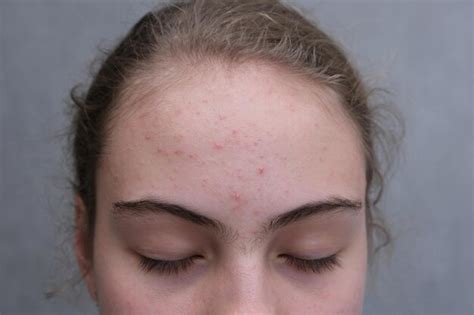 Premium Photo Acne Teenage Girl With The Pimples On Her Face