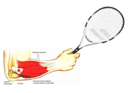 Tennis Elbow On Emaze