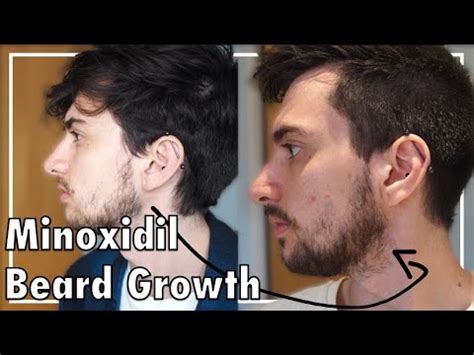 I'm actually getting sick of it and not applying twice daily like i was, mostly because i'm tired of it drying out my does anyone have a before/after picture of someone actually going from no beard to beard, as opposed to from no beard to scruff? Minoxidil Beard Growth: Three Months - YouTube