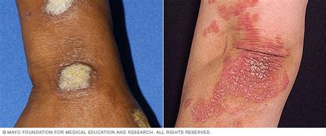 Psoriasis Symptoms Treatment Causes Risk Factors And More Health