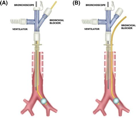 Intraluminal Versus Extraluminal Approach To Bronchial Blocker
