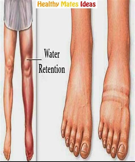 What Causes Water Retention And How To Avoid It Retencion De