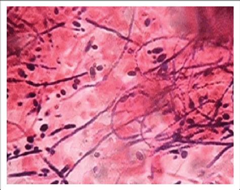 The Candida Hyphae Along With Budding Yeast Cells Under The Electron