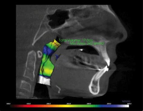 3d Imaging For Better Diagnosis And Treatment Of Pediatric Airway And