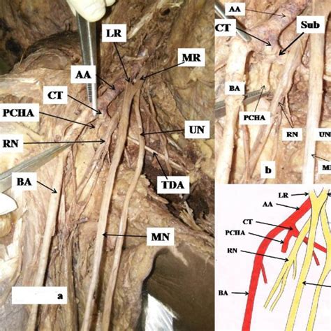 Showing The Branches Of The Axillary Artery As Described In Standard