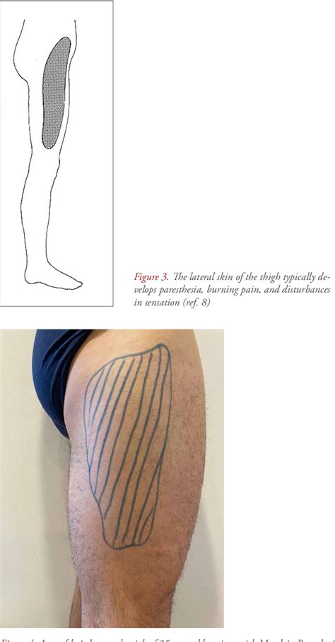 Table From Meralgia Paresthetica Lateral Femoral Cutaneous Nerve