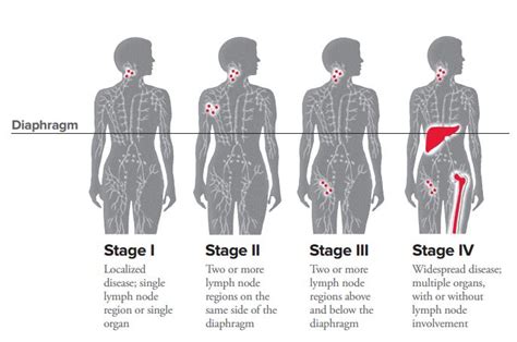Hodgkins Lymphoma Stage Four Prognosis