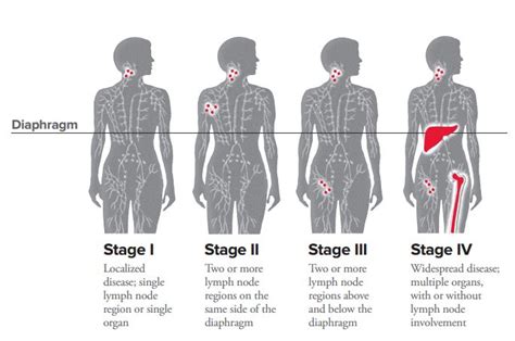 Hodgkin Lymphoma Staging Leukemia And Lymphoma Society