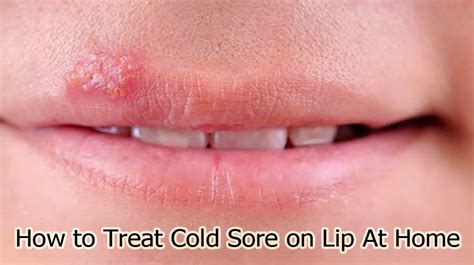 How To Treat Cold Sore On Lip At Home