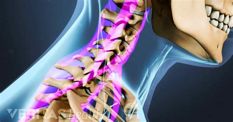 Neck Strains Affect The The Muscles And Tendons Of The Cervical Spine