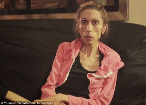 Woman Who Suffers Chronic Anorexia Is Almost As Skinny As A Skeleton