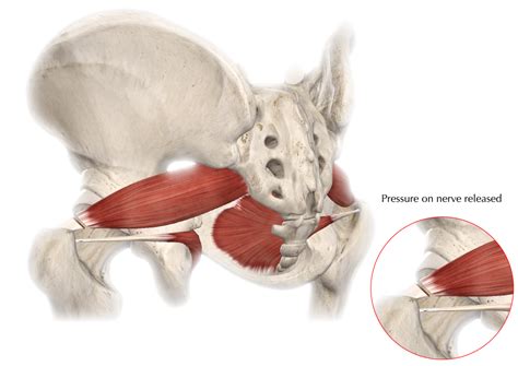 Piriformis Syndrome Faqs Hip And Pelvis Doctor Articles Asia