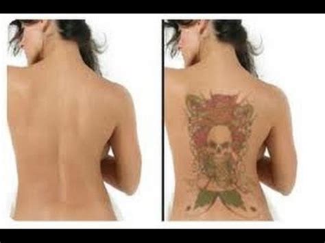 Everyone comes in with different skin and of course what do you think about these laser removal progress shots? Tattoo Removal Boston MA - 7 Things You Should Know Before ...