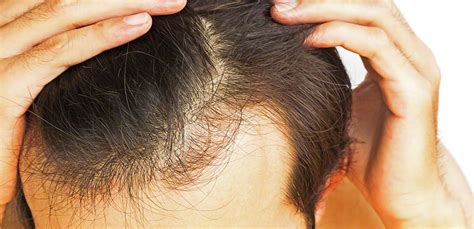 Types Of Hair Loss Treatments Zolooz