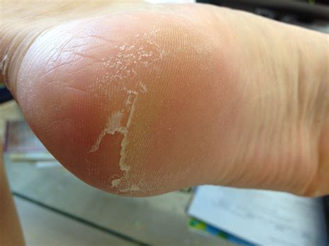 skin peeling on bottom of feet