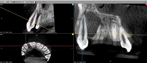 Radiant Screen Capture Lateral Periodontal Cyst Endonet Consulting