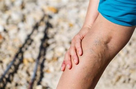 Varicose Veins Of The Legs These Symptoms Should Not Be Overlooked